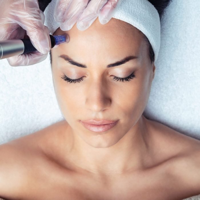 dermapen1